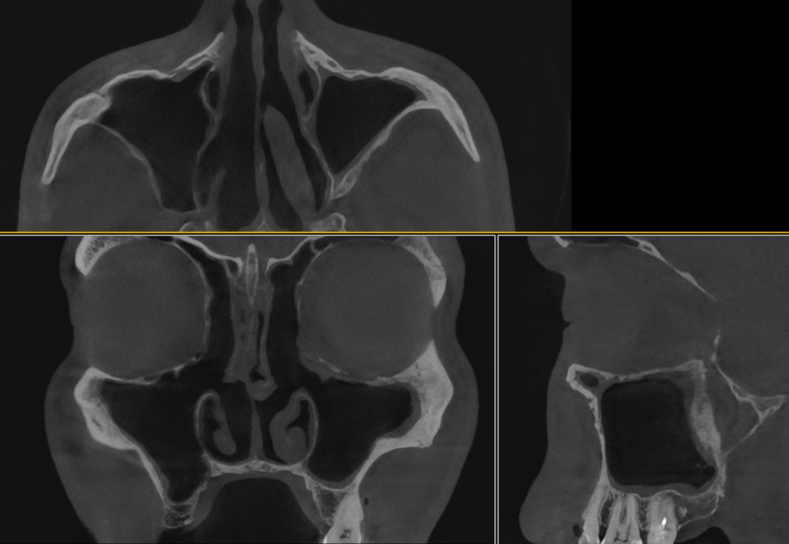 Компьютерная томография после лечения