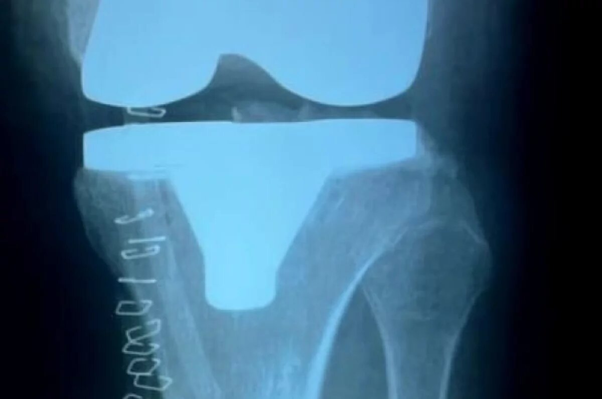    Нижегородские врачи прооперировали женщину с разрушенным коленом