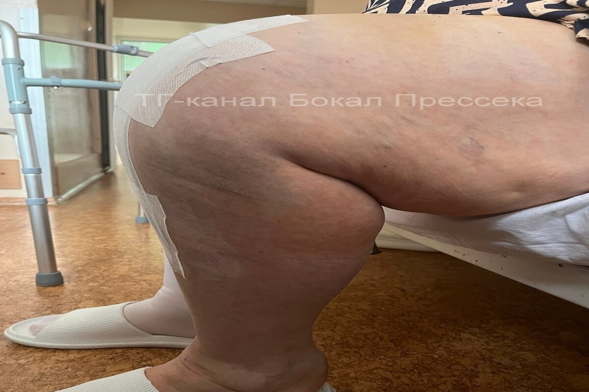    Сейчас пациентка чувствует себя лучше и начинает ходить