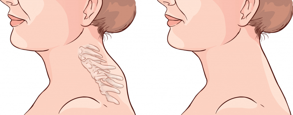 Холка на шее: почему появляется и как от неё избавиться