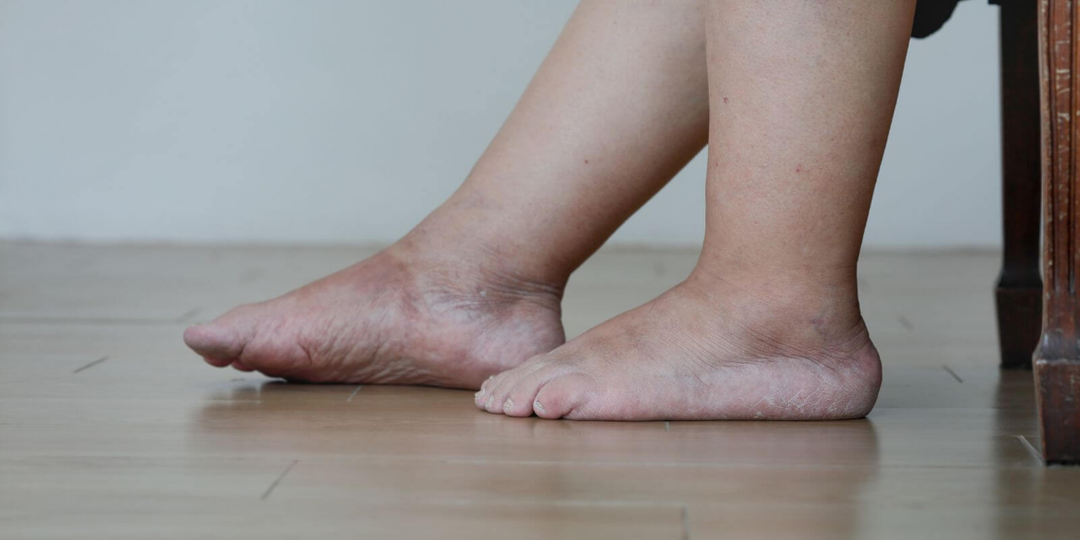 Как избавиться от отеков: 9 полезных советов от врача