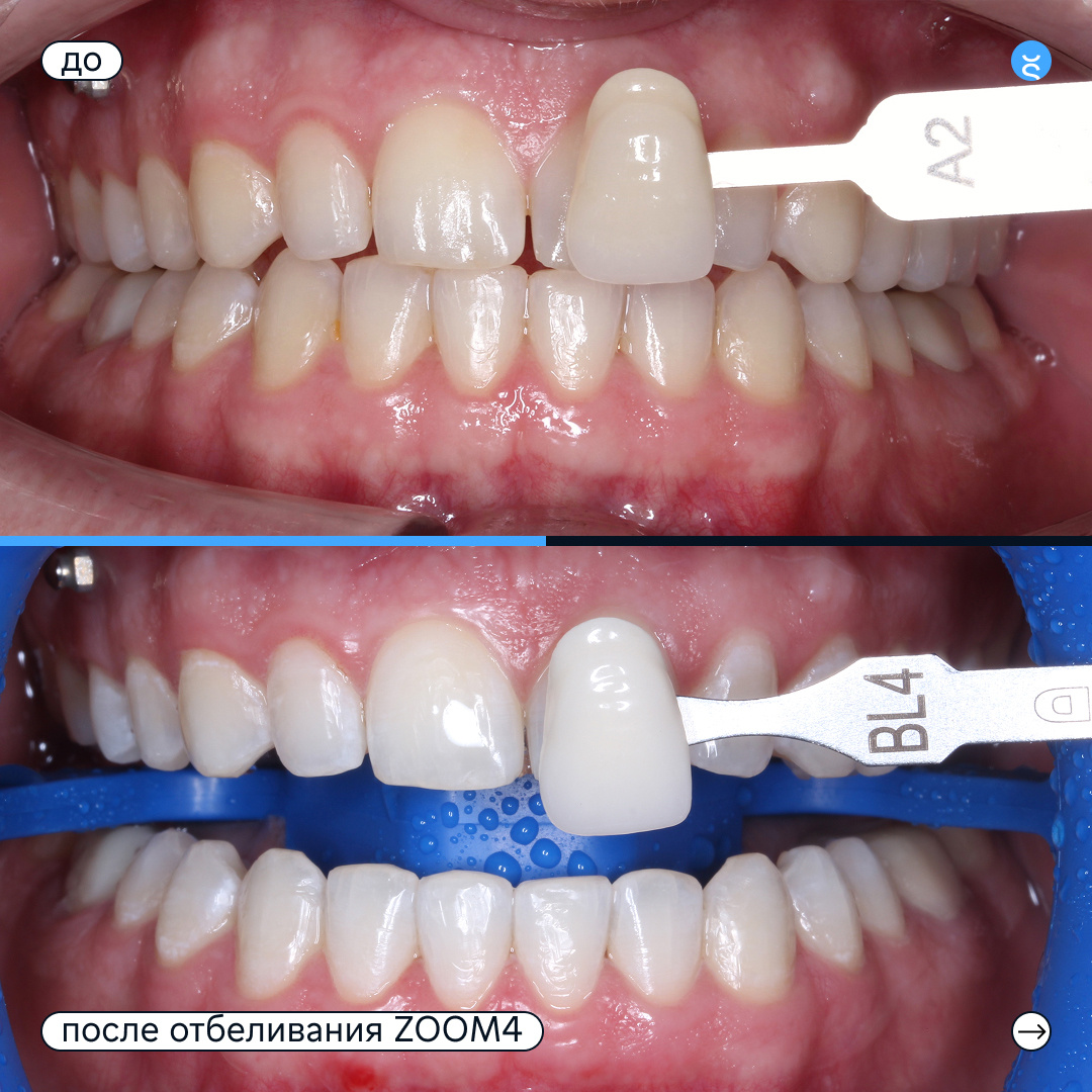 До и после отбеливания