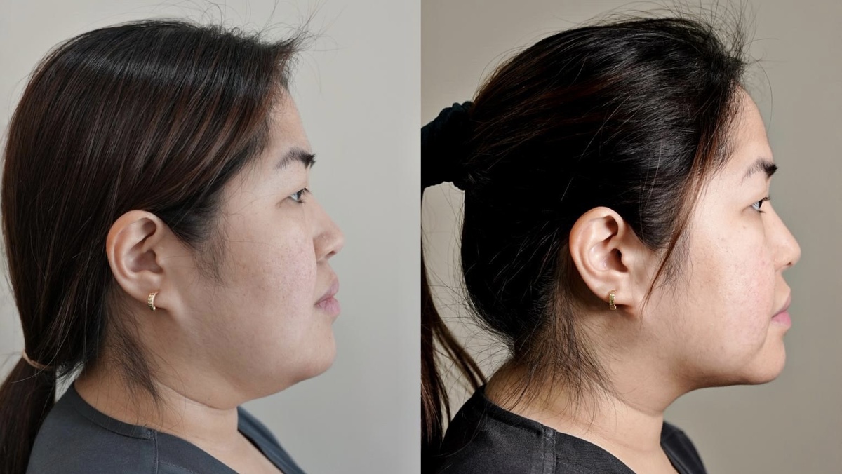 Результат спустя 3 месяца после процедуры в MED YU MED