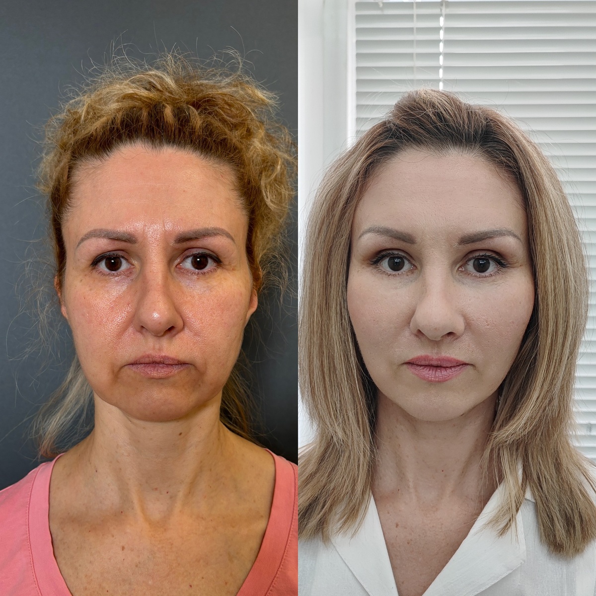 Комплексное хирургическое омоложение лица: 1 месяц после операции. Хирург к.м.н. Остринская Т.В.