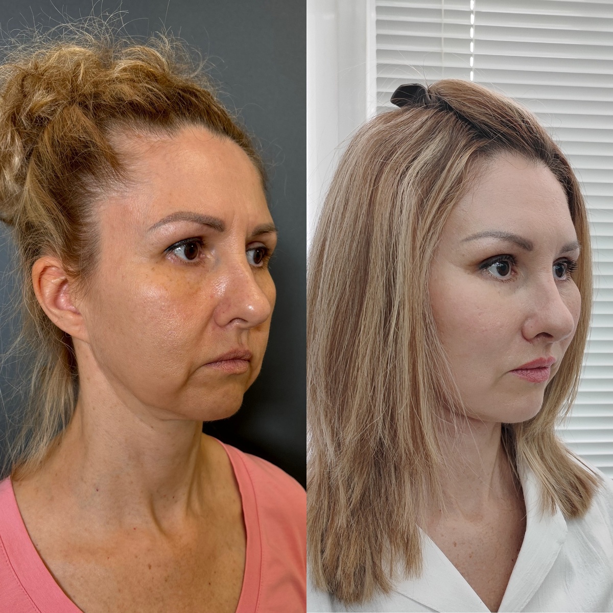 Комплексное хирургическое омоложение лица: 1 месяц после операции. Хирург к.м.н. Остринская Т.В.