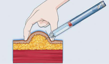 Схематичное изображение техники подкожной инъекции из открытых источников.
