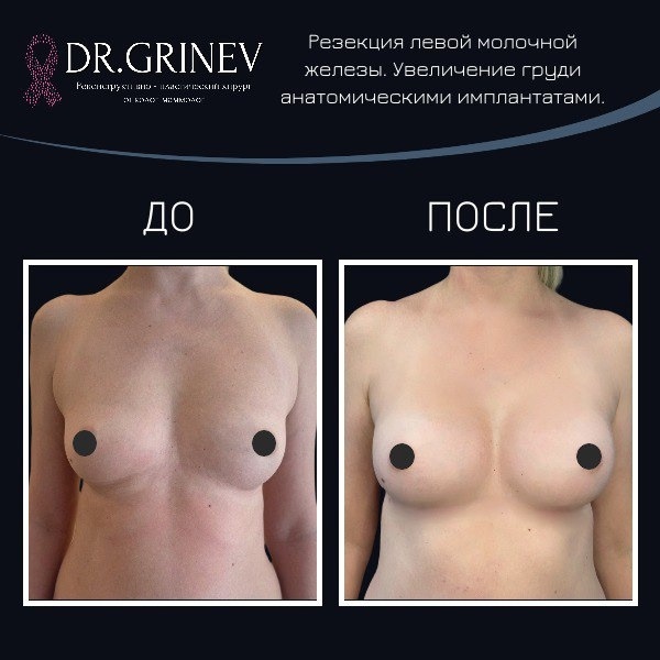 📸 ДО/ПОСЛЕУвеличение груди анатомическими имплантатами. Резекция левой молочной железы по поводу доброкачественной опухоли. 4 мес после операции.〰〰〰〰〰〰〰〰〰〰〰🖥 Платная онлайн консультация: vk.com/market-226124771?w=p...📆 Записаться ко мне на очный прием:📲 +7 (950) 026-35-25 (ватсап) или телеграм t.me/drivangrinev#онкологмаммологспб #онкологмаммолог #пластическийхирургспб #пластикагруди #увеличениегруди #маммопластика