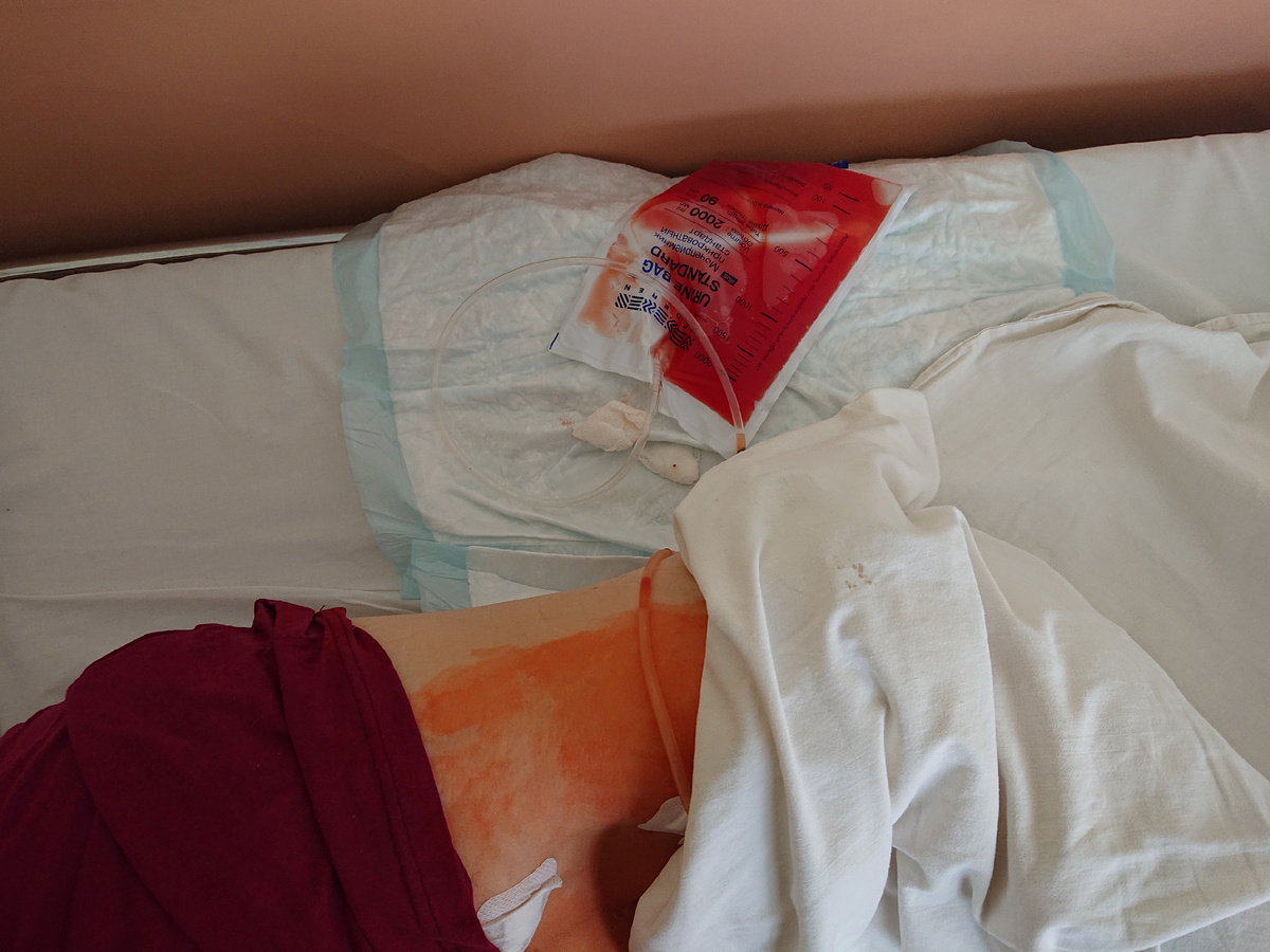 Дренаж после лапароскопии