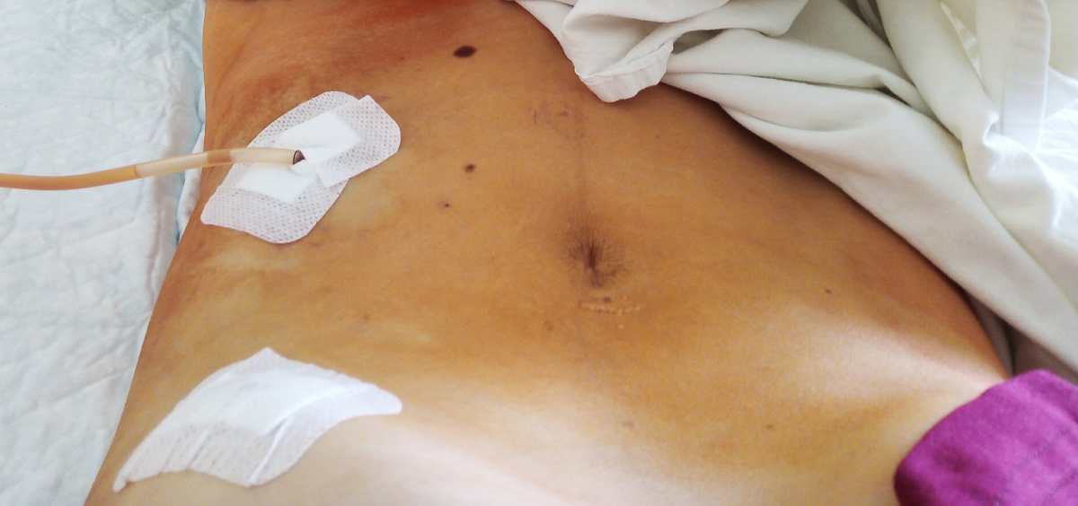 Живот после лапароцентеза и лапароскопии