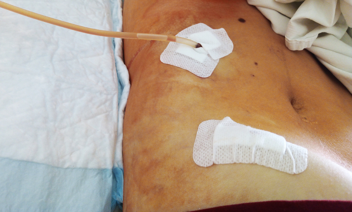 Дренажная трубка из живота через несколько часов после лапароскопии