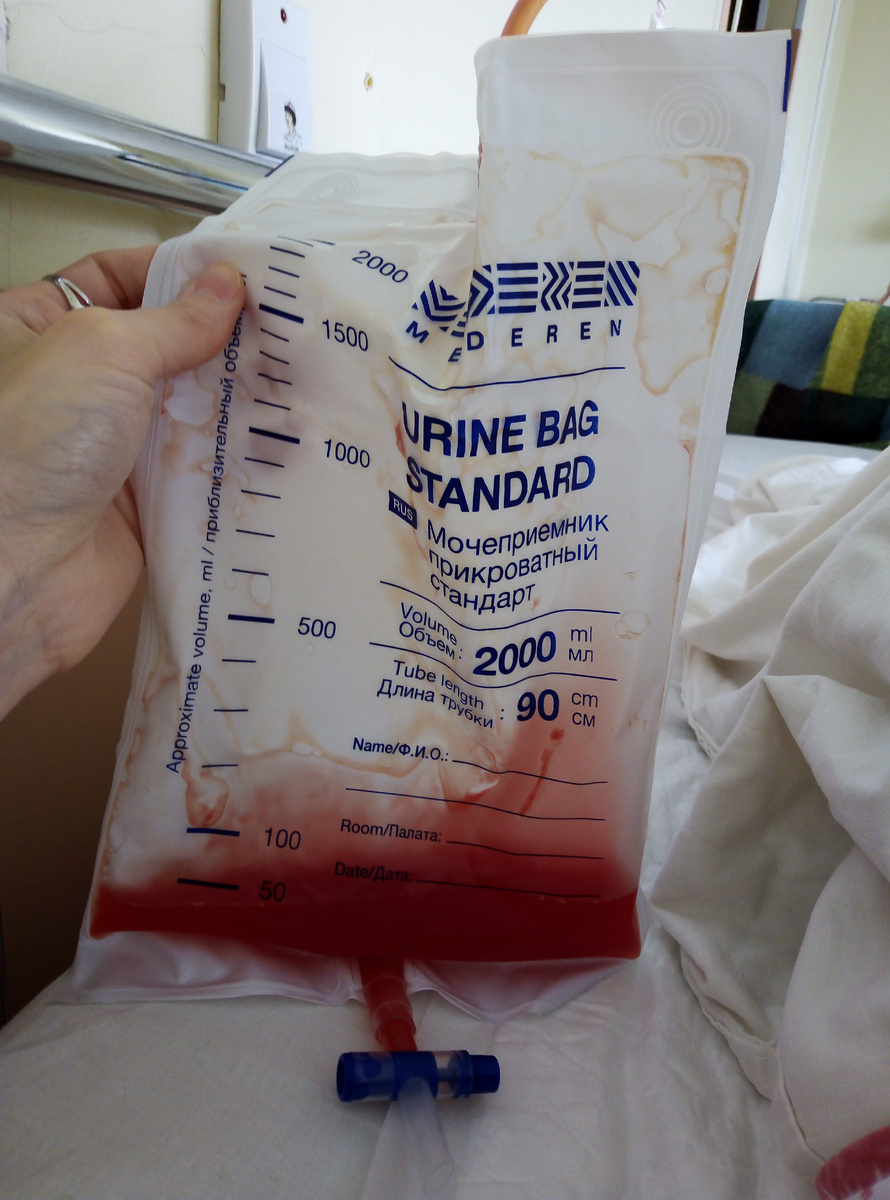 Асцитическая жидкость после биопсии