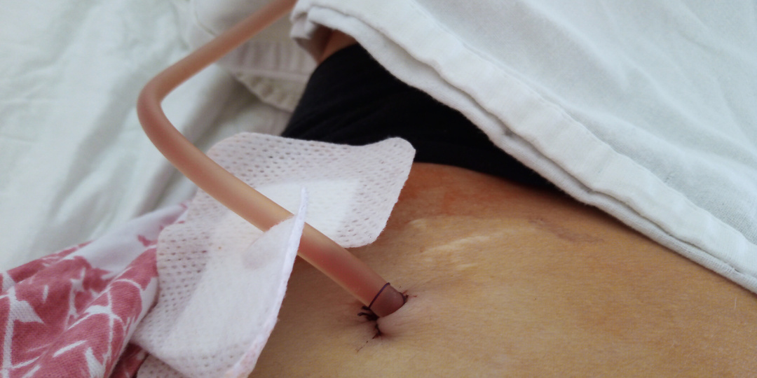 Хирург: «Лучше бы это был рак» На лапароскопии обнаружены метастазы без раковых клеток. История болезни ч. 98