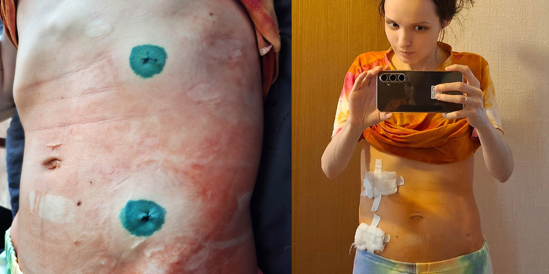 Ушла домой на 3 день после операции. Выписка из онкодиспансера. История болезни ч. 99