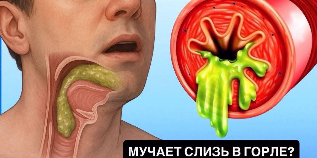 Почему скапливается слизь в горле: 10 главных причин, о которых стоит знать каждому