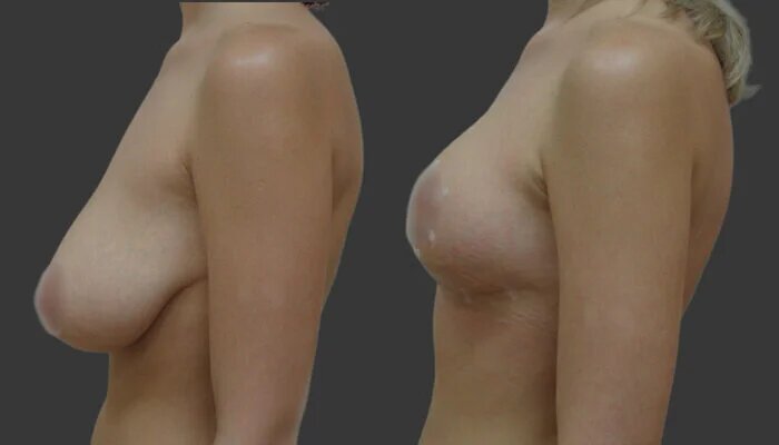 #подтяжкагруди