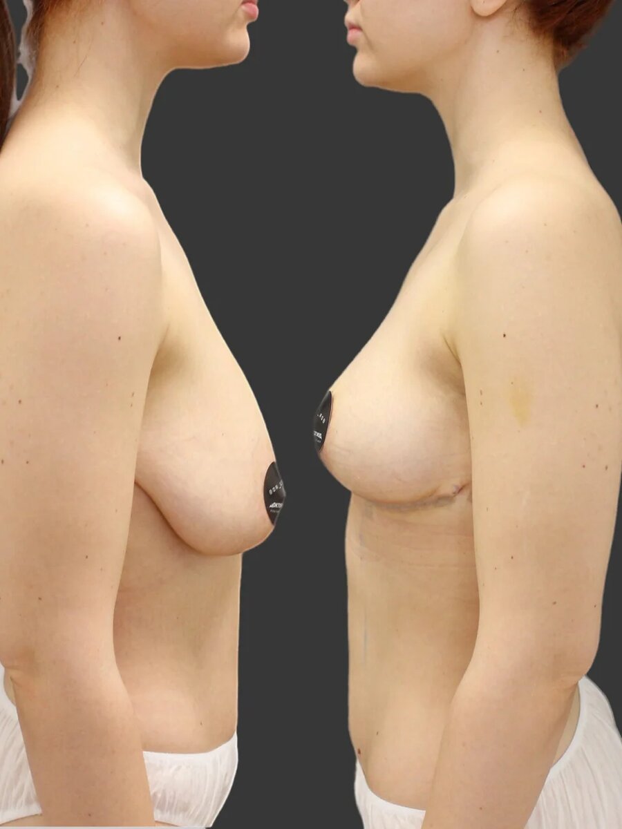 #подтяжкагруди