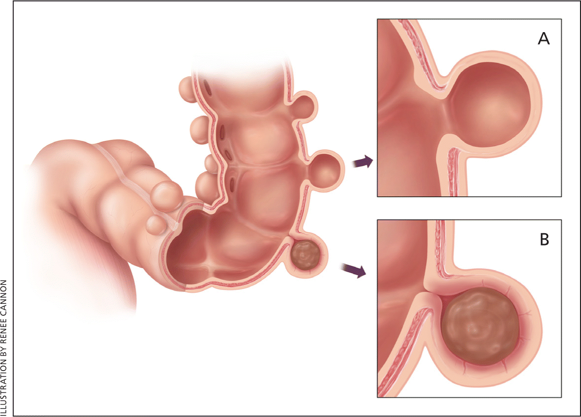 А - дивертикул с широким устьем, не заполнен кишечным содержимым. В - дивертикул с узким устьем, заполнен кишечным содержимым, более склонен к воспалительному процессу.