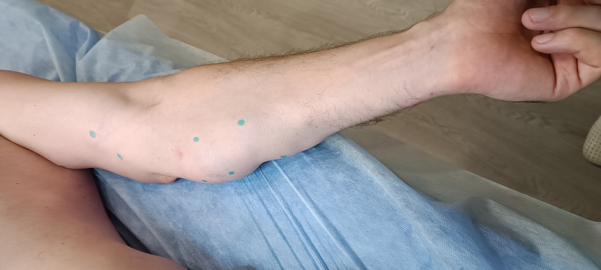 Множественные липомы руки