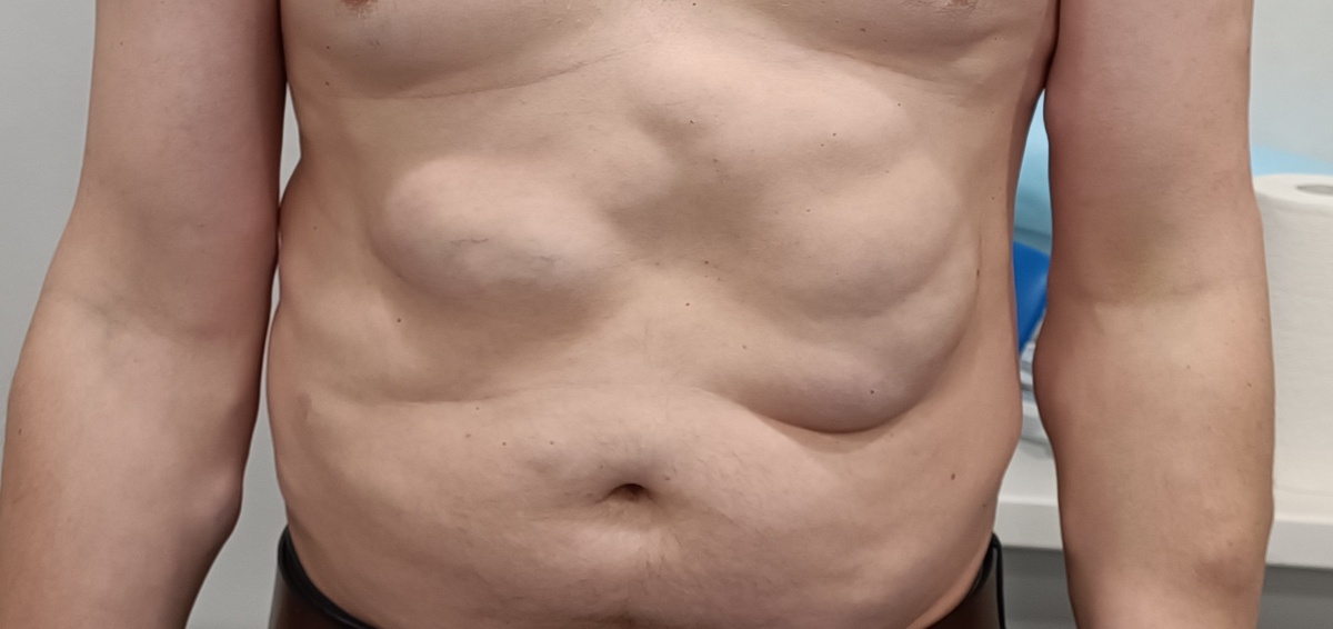 Липоматоз на теле