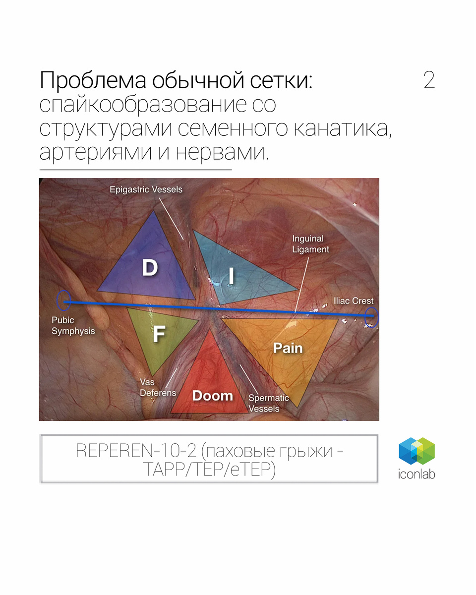 Мы не просто создали сетку. Мы решили ключевую проблему TAPP/TEP методик — защиту семенного канатика и сосудов от спаечного процесса и хронической боли.