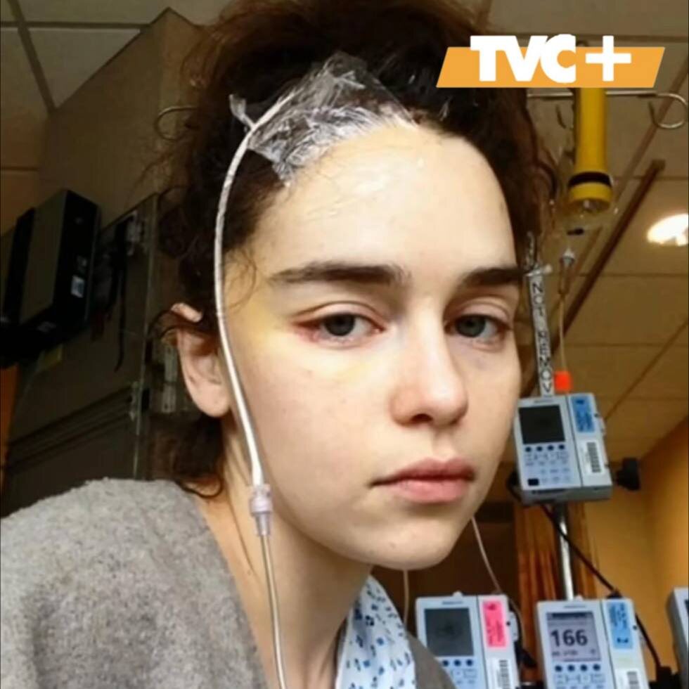 Эмилия после операции.