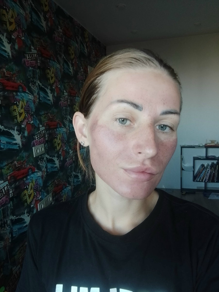 Первые сутки после пилинга Джесснера. Вроде и не страшно.