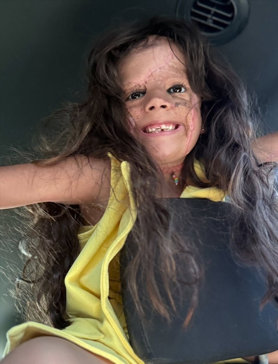 Сейчас лицо малышки выглядит так. Фото: соцсети семьи Феннер