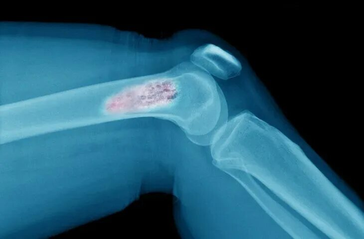 Рак костей тоже бывает: почему он развивается и влияют ли на его возникновение переломы и травмы