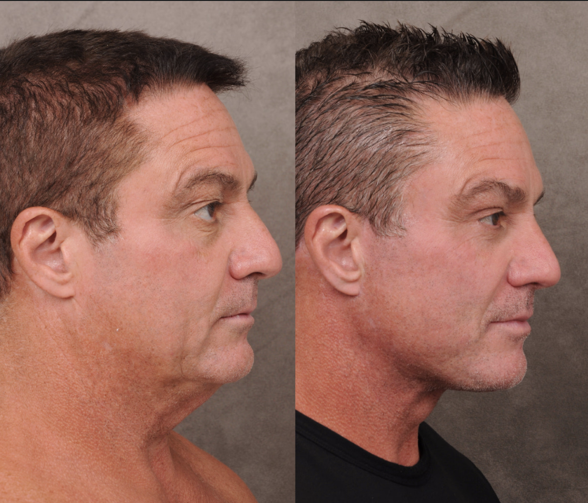 Фотография одного из айтишников до и после операции