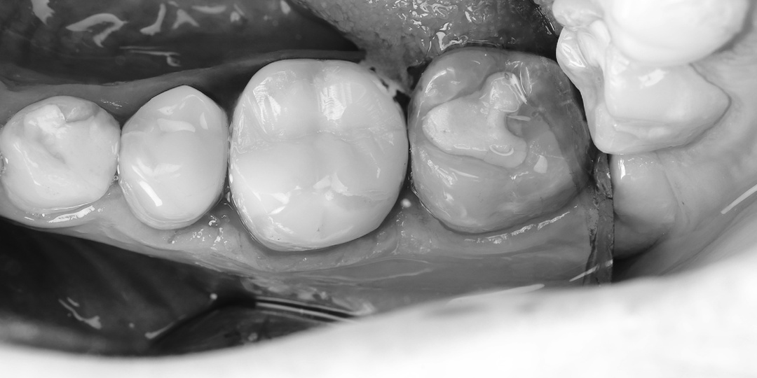 Пациенту 23 года, инсульт две недели назад и кариес до пульпы - история одного лечения