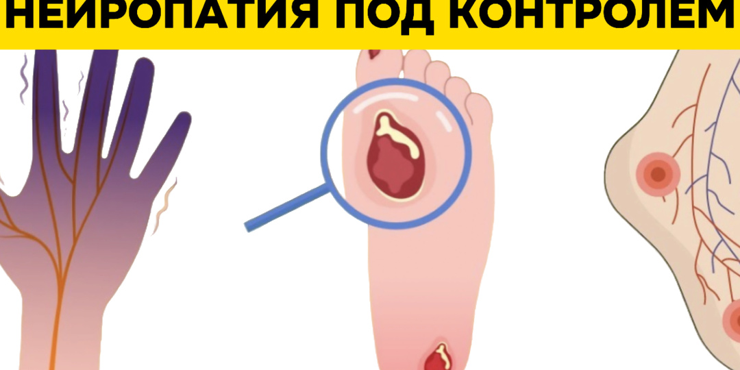 Диабет и стопы: "руководство" по защите от нейропатии по версии врачей