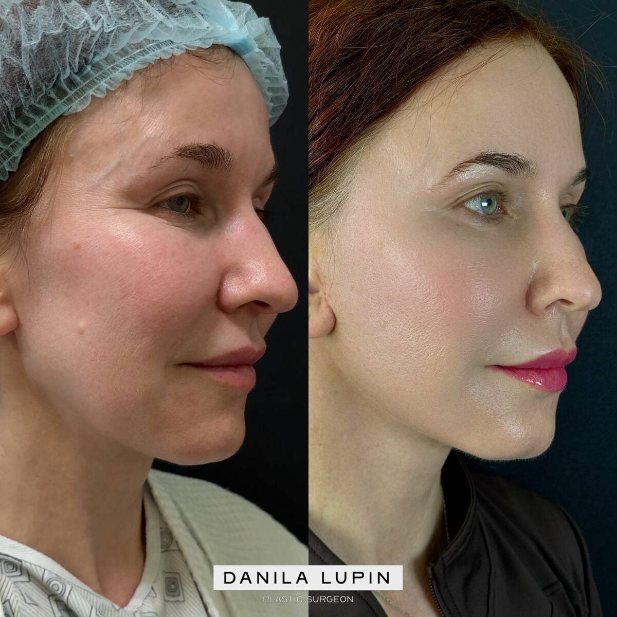 Здесь и далее мои пациентки. На фото SMAS-подтяжка нижней трети лица с платизмопластикой и липосакцией субментальной зоны