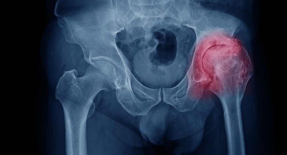 Как справиться с коксартрозом тазобедренного сустава и вернуть себе подвижность