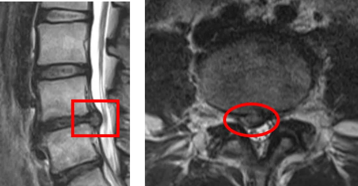 Межпозвночная грыжа на МРТ-снимке: сагиттальный (слева) и аксиальный (справа) срезы