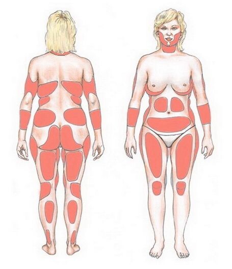 Схематичное изображение мест, где чаще всего могут образовываться жировые ловушки.