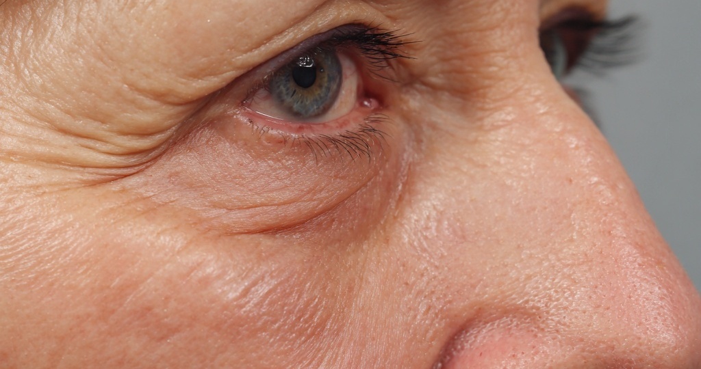 Почему появляются мешки под глазами