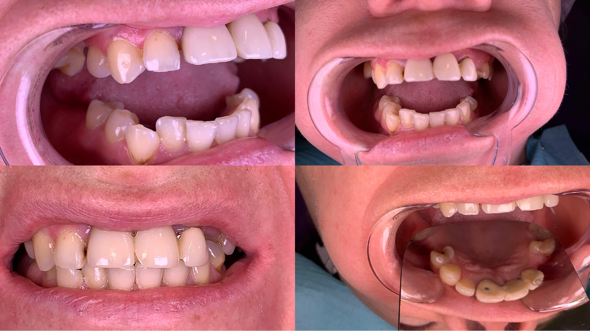 Фото улыбки до операции