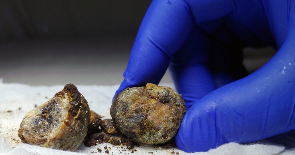 Что такое калькулёзный холецистит и какие желчные камни можно растворить? Отвечает Сергей Вялов