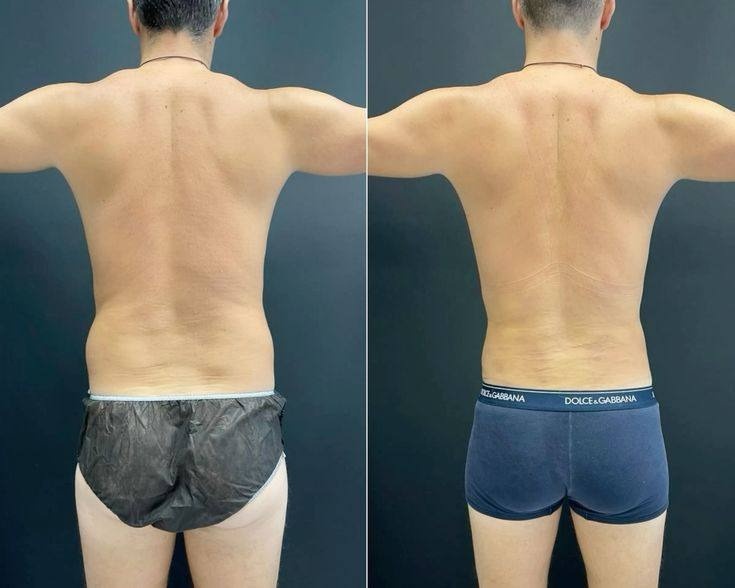 Липосакция живота с прорисовкой спортивных линий, липосакция пояснично-боковых областей, спины и груди. Результат спустя 2 недели после операции