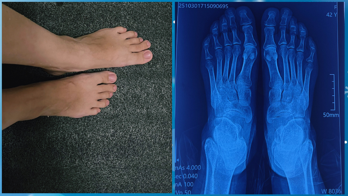 Вот мои стопы и рентген, на фото видно второй  палец деформирован, деформирующих артроз, на рентгене не так как на фото, деформация меньше кажется 
