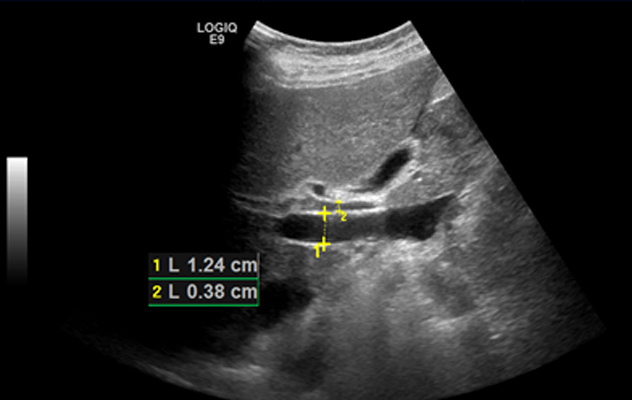 Рис. 1. Исследование воротной вены. 2016 год.