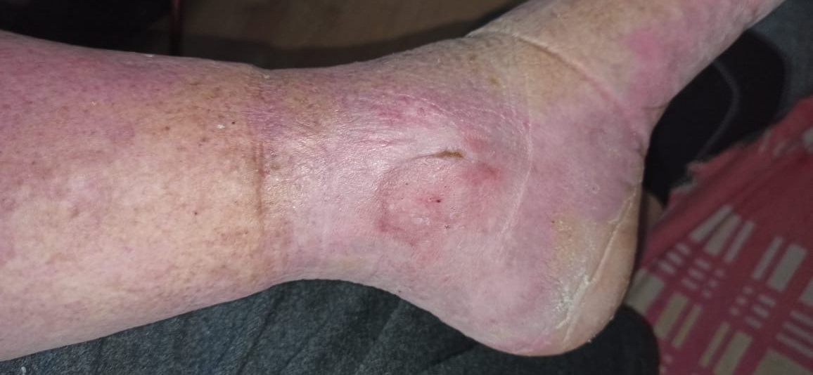 Заживление трофической язвы через 3 недели после операции ЭВЛК (при варикозе). Фото из личного архива. 