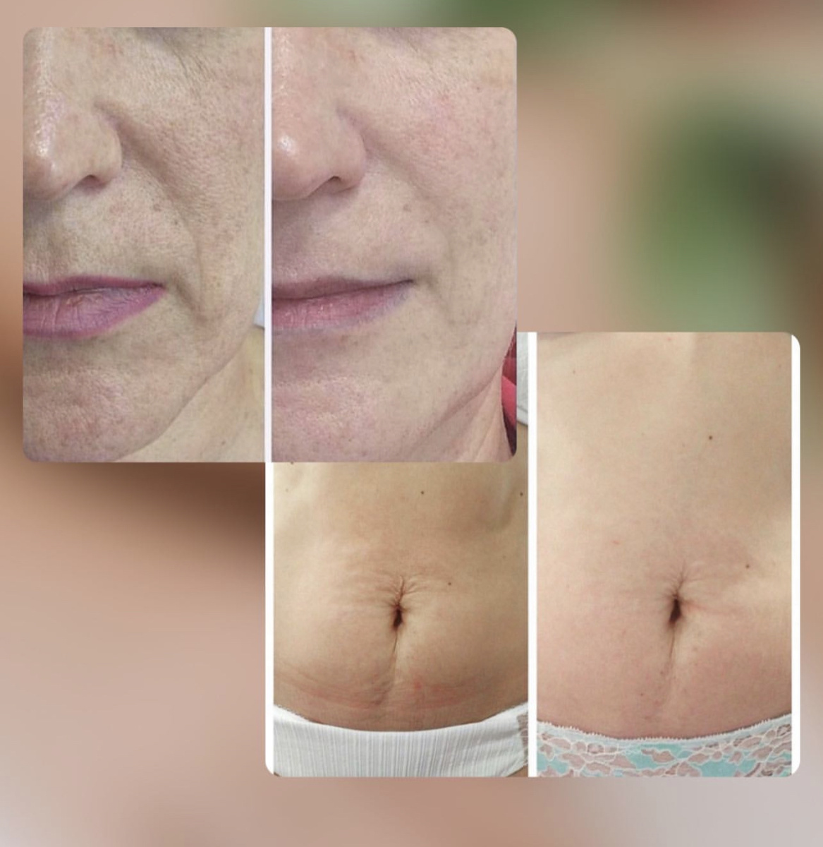 Результаты процедур на аппарате Floracel