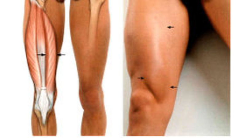 Медиальная широкая мышца: из-за ее слабости болят колени | Почему не работает и что делать