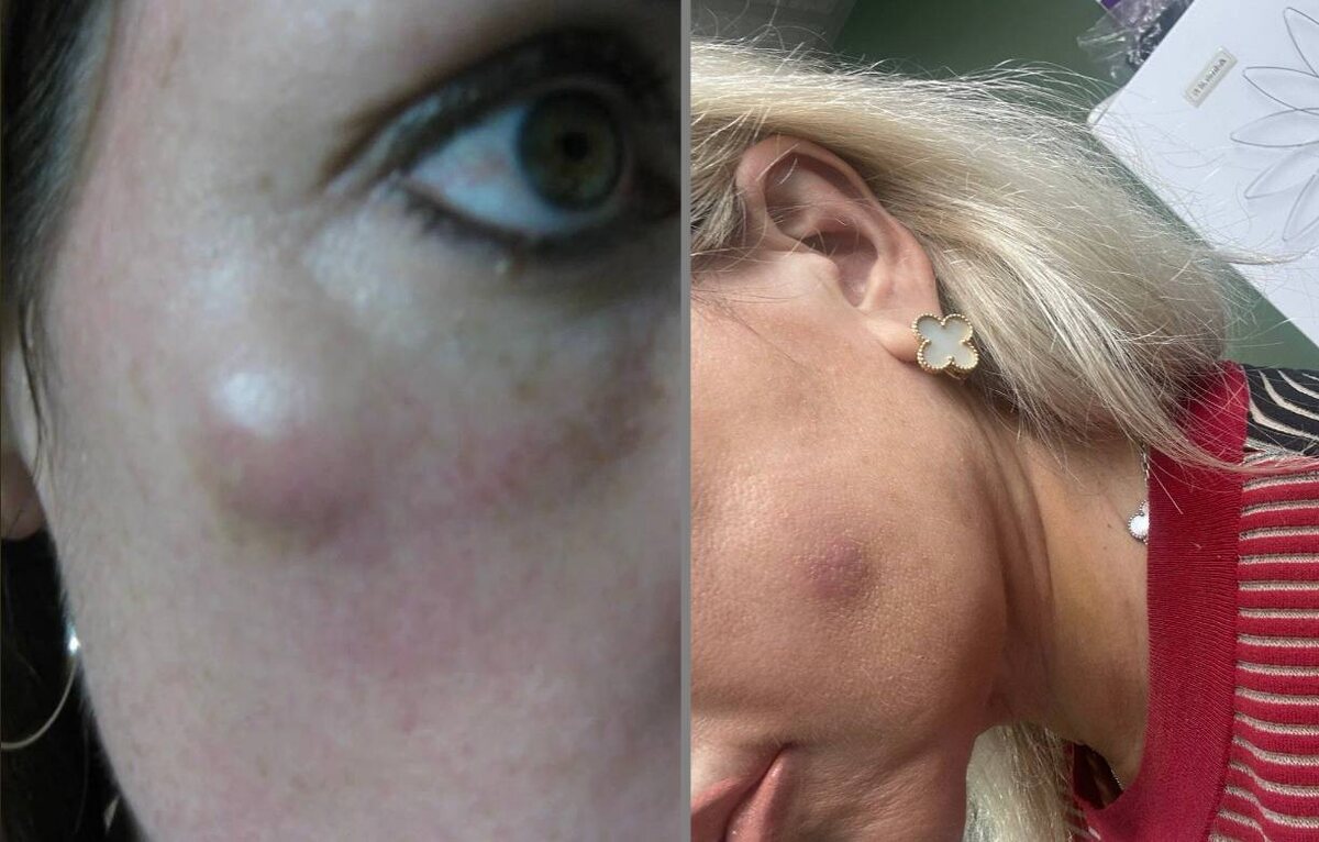 Пример абсцесса после инъекционной процедуры. 