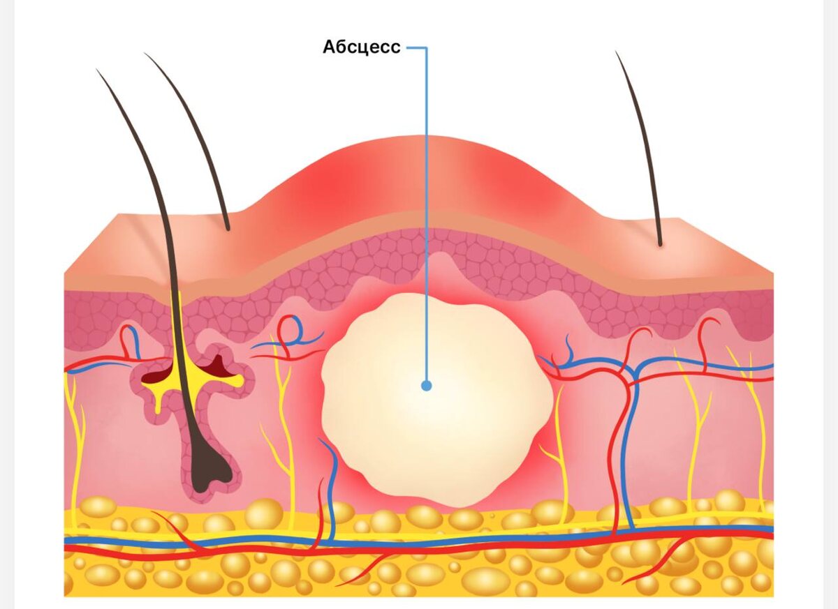 Наглядная схема образования абсцесса. 
