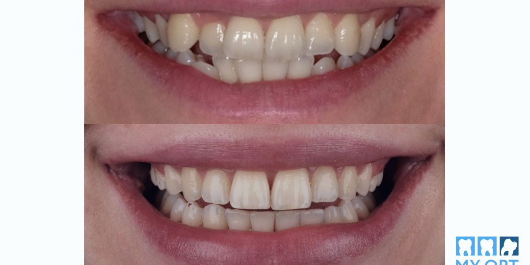 Как поставить брекеты без отказа от путешествий. Реальный случаи