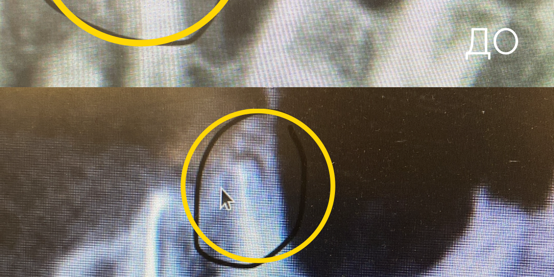 Киста в зубе?