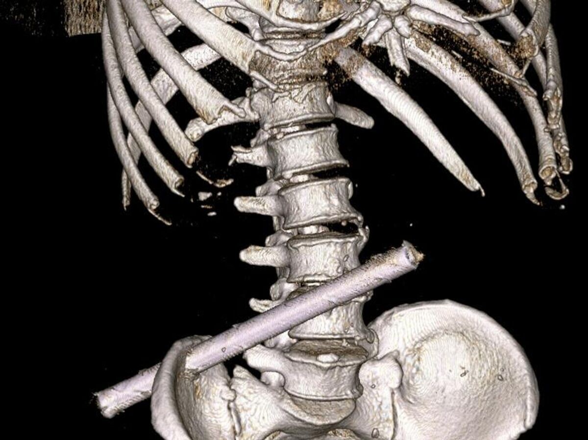    Врачи из Новочебоксарска спасли мужчину, вытащив 25-сантиметровую трубу, воткнувшуюся ему в тело при падении© Минздрав Чувашии