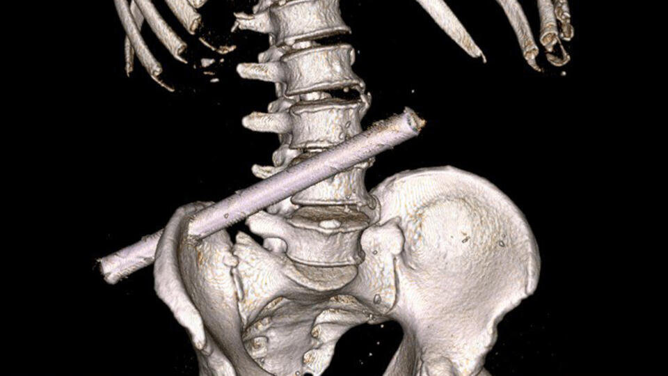     Житель Чувашии три дня ходил с металлической трубой в теле t.me/Минздрав Чувашии